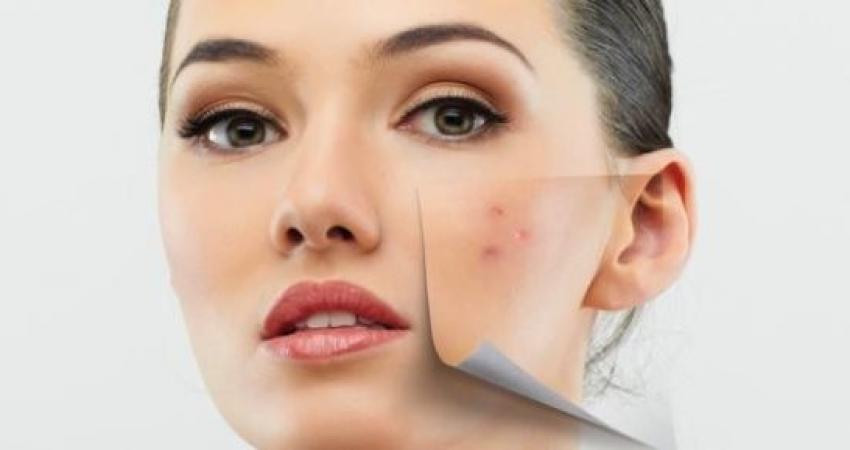 7 مجموعات أطعمة فعّالة جداً في محاربة حب الشباب .. تعرفي عليها